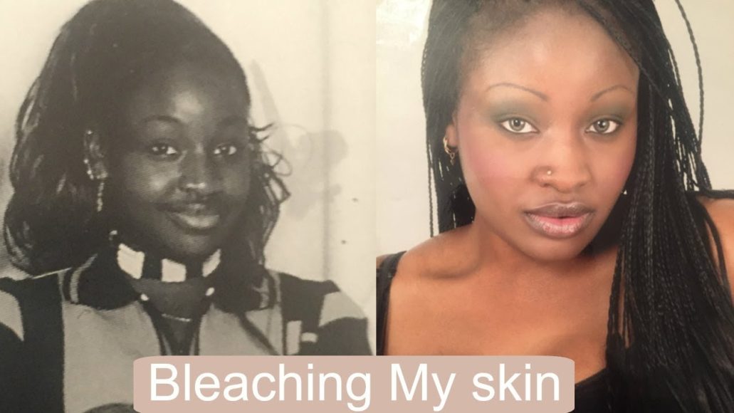 skin bleaching